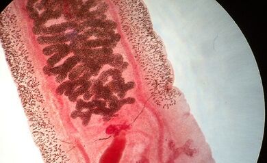 Anquilostomosis pada manusia