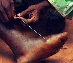 Parasit di kaki seseorang