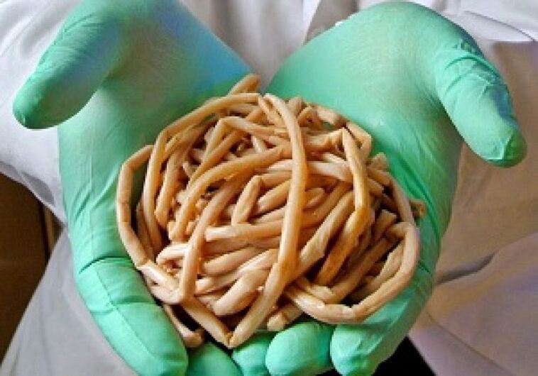 Cacing parasit dari badan manusia